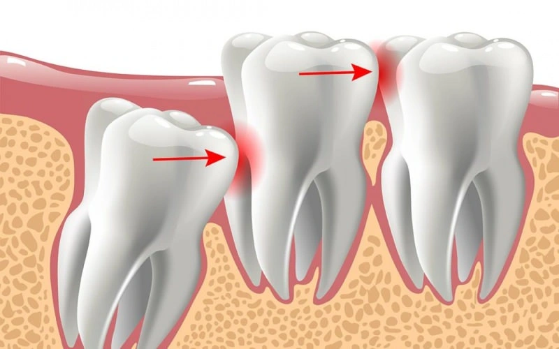Cerrahi Diş Çekimi
